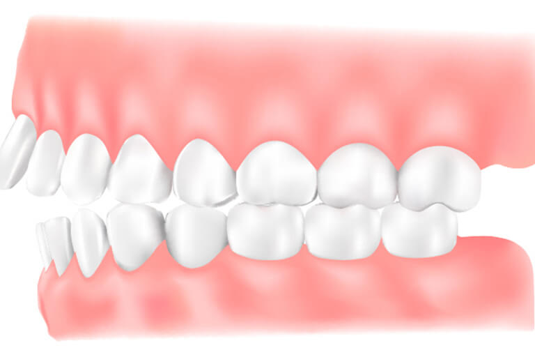 上下顎前突(じょうかがくぜんとつ)