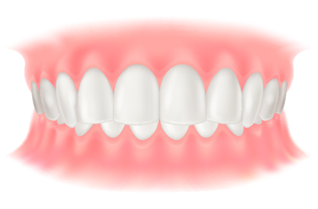 過蓋咬合(かがいこうごう)